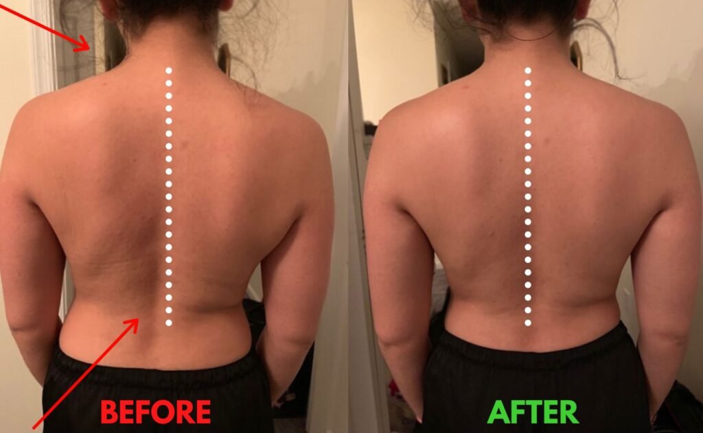 Before and after posture correction showing improved spinal alignment from in-home massage therapy